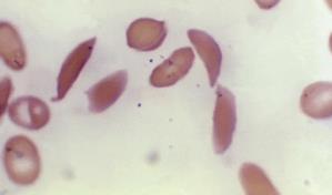 FDA revisará terapia genética para trastorno de los glóbulos rojos
