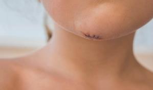 ¿Cómo influye tu alimentación en la cicatrización de heridas?