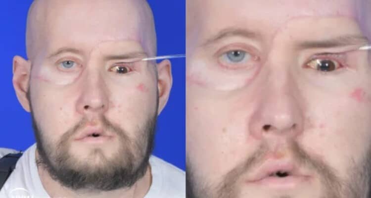 No se sabe si Aaron James recuperará también la vista en el ojo trasplantado