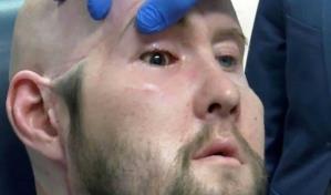 Un hospital de Nueva York logra por primera vez trasplantar un ojo entero a un paciente