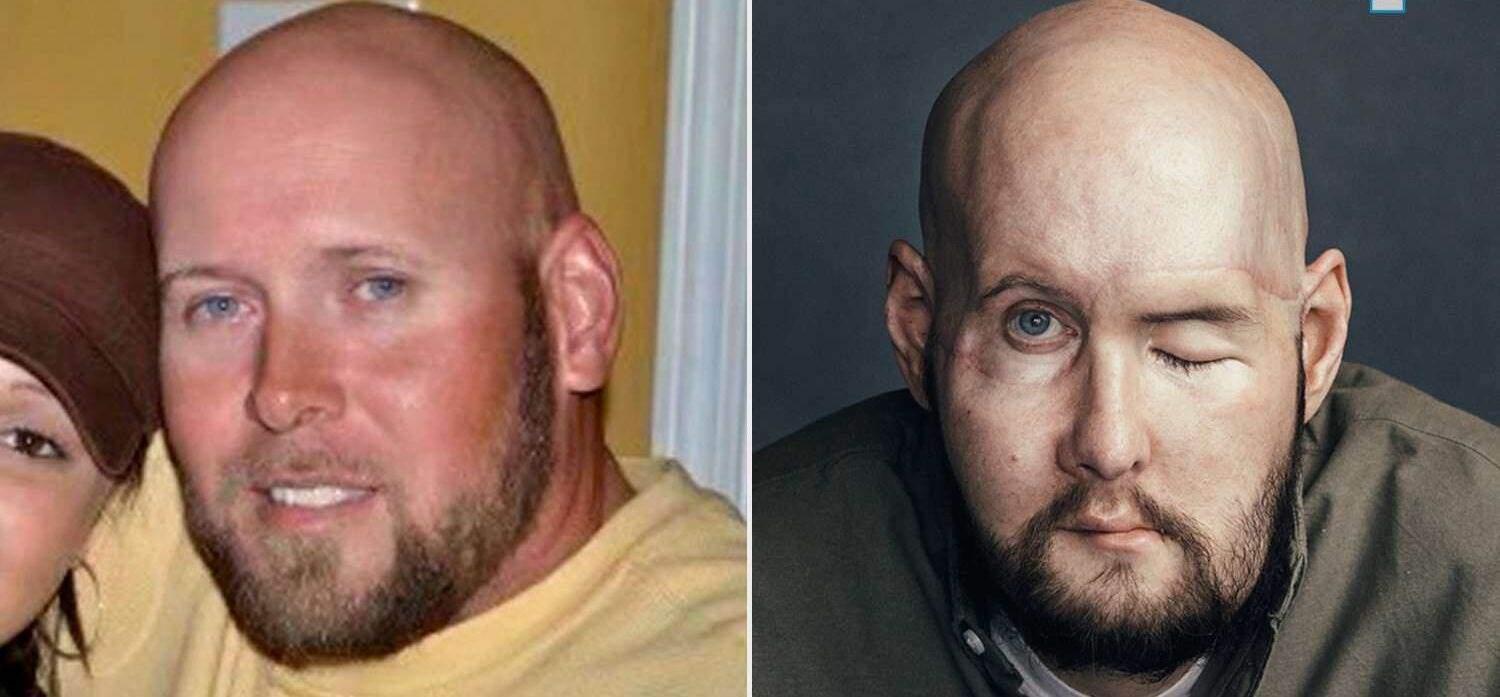 Aaron James antes y después del accidente