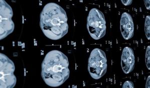 Inteligencia artificial china ayuda a detectar el cáncer de páncreas en una fase temprana