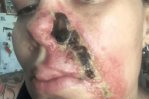 Mujer reporta quemaduras en su rostro tras inyección de Botox mal administrada en EE.UU. Mujer reporta quemaduras en su rostro tras inyección de Botox mal administrada en EE.UU.