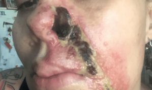 Mujer reporta quemaduras en su rostro tras inyección de Botox mal administrada en EE.UU.