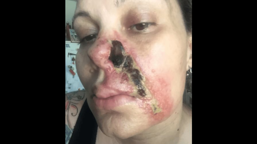 Mujer reporta quemaduras en su rostro tras inyección de Botox mal administrada en EE.UU.