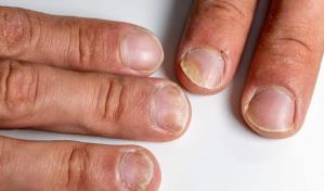 Mujer demanda restaurante de Nueva York tras encontrar un dedo humano en su ensalada