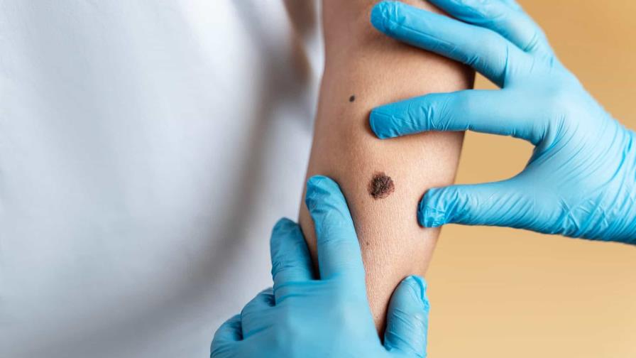 Una vacuna reduce a la mitad el riesgo de recaída en cáncer de piel