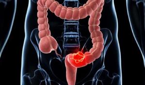 Una vacuna muestra potencial frente a las recaídas de cáncer de pancreas y colon