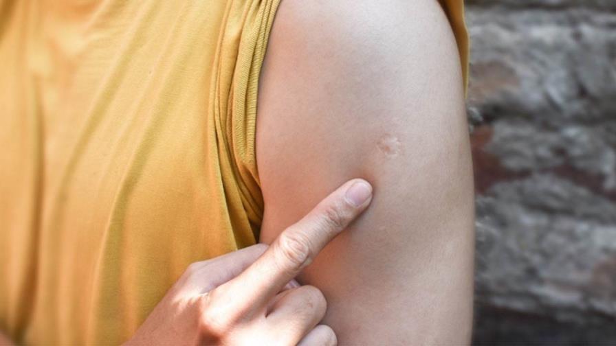 ¿Cuál es la vacuna que deja una cicatriz redondeada en el brazo?