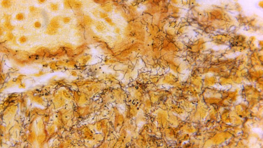 Los casos de sífilis en EE.UU. aumentan a los niveles más altos en los últimos 70 años Los casos de sífilis en EE.UU. aumentan a los niveles más altos en los últimos 70 años