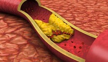 Se&ntilde;ales sutiles que pueden alertar de enfermedades vasculares
