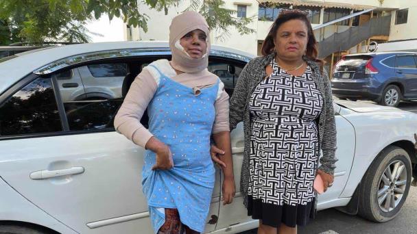 Mujer con quemaduras graves al ser atacada con aceite caliente; acusa a su expareja de la agresión