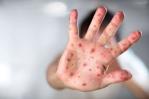 OMS: más de la mitad de los países sufrirán alto riesgo de brotes de sarampión este año