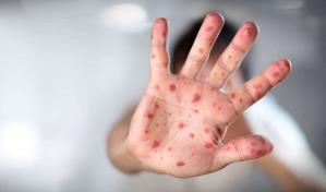 OMS: más de la mitad de los países sufrirán alto riesgo de brotes de sarampión este año