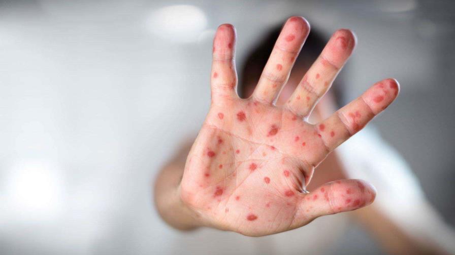 OMS: más de la mitad de los países sufrirán alto riesgo de brotes de sarampión este año