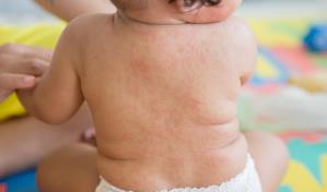 Por cada caso positivo de sarampión, se esperan hasta 18 nuevos contagios