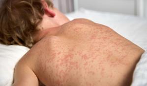 La amenaza del sarampión y otras enfermedades reemergentes