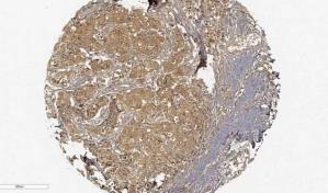 Identifican una nueva diana teraupeútica contra el cáncer de mama