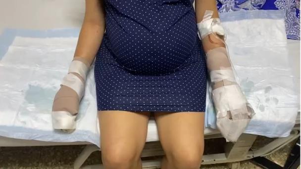 Mujer se quemó las manos al quitarle disfraz en llamas a su hijo en carnaval de Salcedo