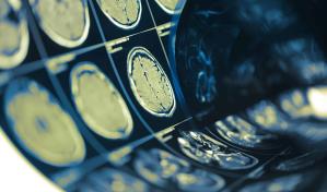 Día Internacional de los Tumores Cerebrales: causas y riesgos