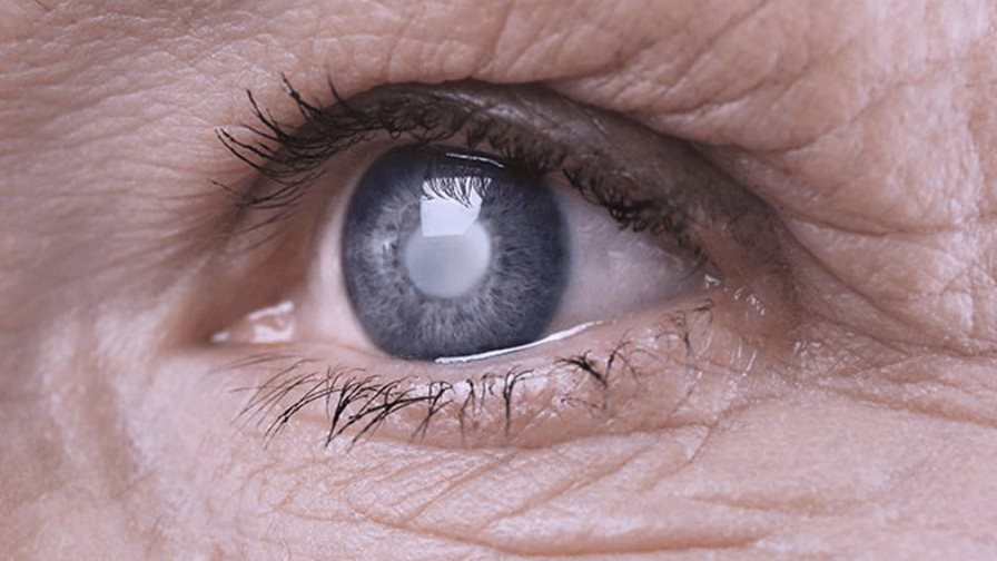 Día Mundial del Glaucoma, la enfermedad silenciosa que puede acabar con la visión