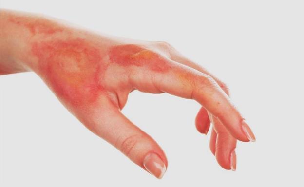 Prevención en Semana Santa: ¿cómo actuar en caso de una quemadura?