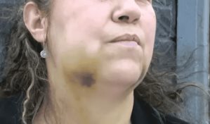 Dominicana en Nueva York recibió un puñetazo que le rompió la mandíbula; agresor en libertad