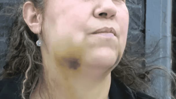 Dominicana en Nueva York recibió un puñetazo que le rompió la mandíbula; agresor en libertad