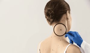 Qu&eacute; es el melanoma, el c&aacute;ncer de piel que afecta a Alejandro Fern&aacute;ndez W.