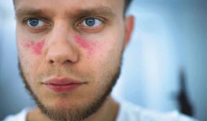 Lupus, una enfermedad de difícil diagnóstico