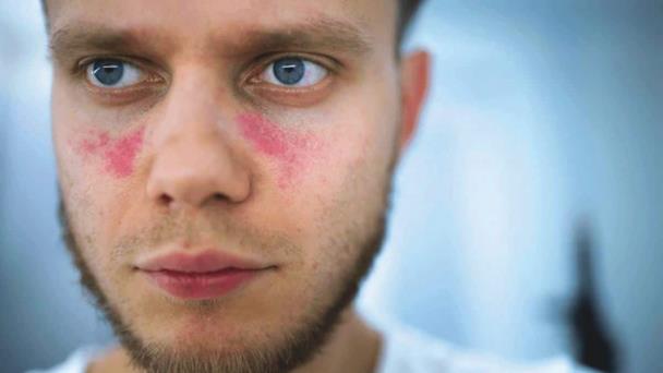 Lupus, una enfermedad de difícil diagnóstico