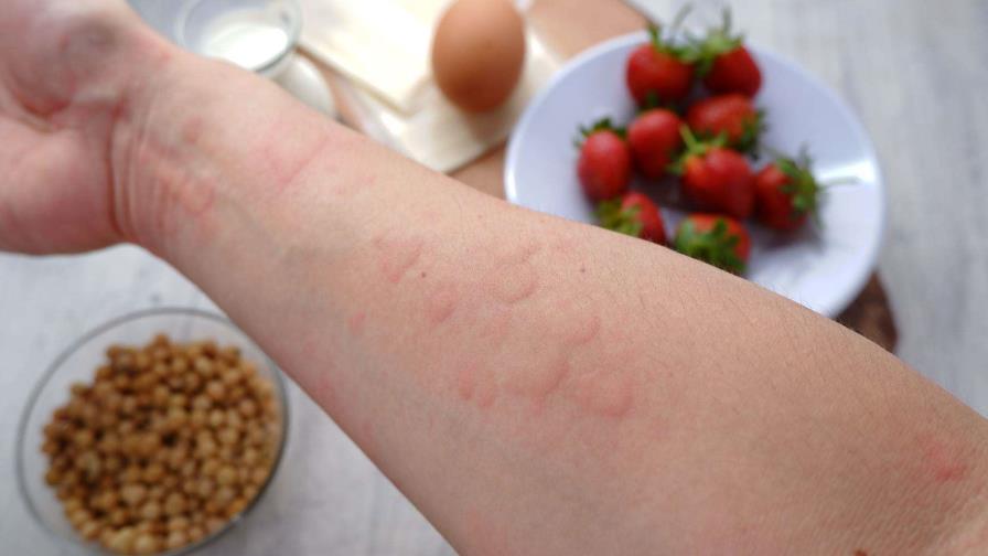 ¿Son las alergias alimentarias una epidemia en aumento o un problema mal diagnosticado?