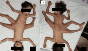 Uno de cada dos millones de gemelos ara&ntilde;a tiene tres piernas, cuatro brazos y 1 pene