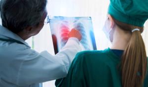 Inmunoterapia, otra alternativa en la lucha contra el cáncer de pulmón