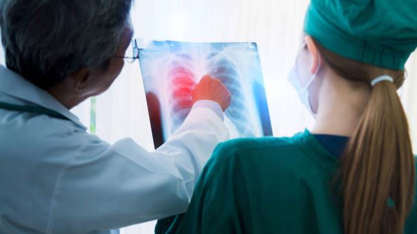 Inmunoterapia, otra alternativa en la lucha contra el cáncer de pulmón