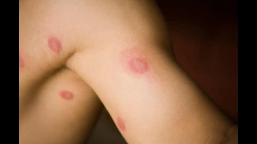 Nueva infección por hongos de transmisión sexual es detectada en Nueva York Nueva infección por hongos de transmisión sexual es detectada en Nueva York