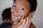 D&iacute;a Mundial del Vitiligo: una condici&oacute;n que afecta a un 2 % de las personas a nivel mundial