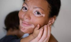 D&iacute;a Mundial del Vitiligo: una condici&oacute;n que afecta a un 2 % de las personas a nivel mundial