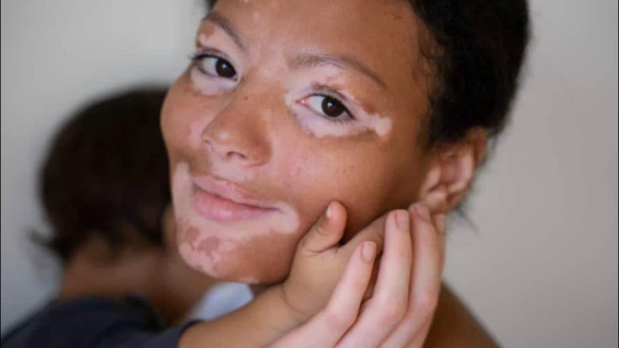 Día Mundial del Vitiligo: una condición que afecta a un 2 % de las personas a nivel mundial