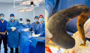 Extraen una bola gigante de cabello del estómago de una joven de 24 años en Ecuador