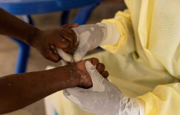 Las autoridades sanitarias de Puerto Rico, vigilantes ante la nueva variante del mpox