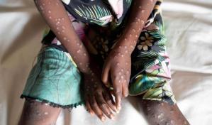 OMS: Expansión de mpox requiere respuesta unificada, pero sin entrar en pánico
