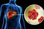 Hepatitis B y C tienen mayor potencial de convertirse en enfermedades crónicas