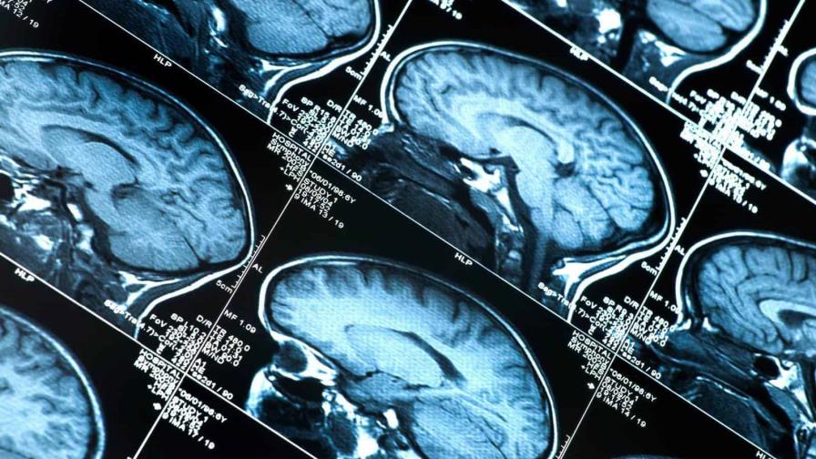 Descubren trece proteínas relacionadas con el envejecimiento cerebral en los humanos