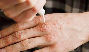 En República Dominicana, 201 personas reciben tratamiento para la lepra