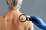 Melanoma: ¿por qué es tan peligroso?