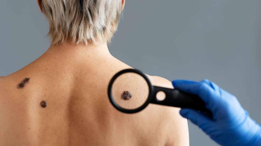 Melanoma: ¿por qué es tan peligroso?