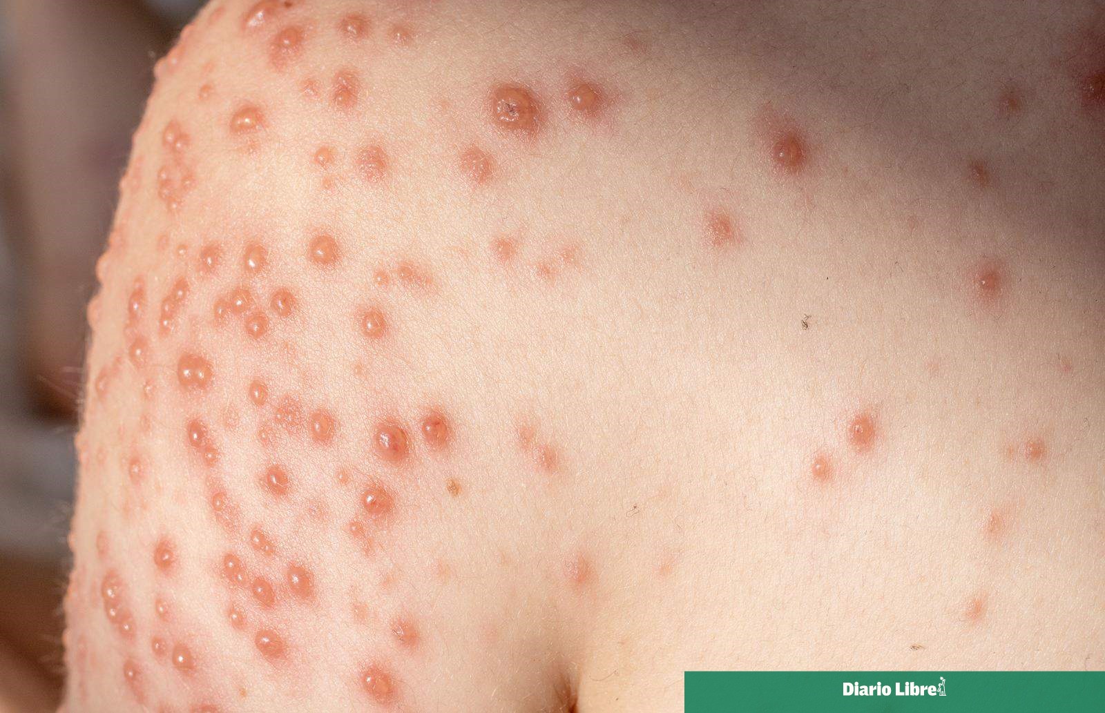 Vaccination: Key to Prevent Chickenpox - News Directory 3