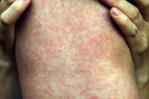 Casos de sarampión en Canada superan los 4,500, la cifra más alta en las Américas
