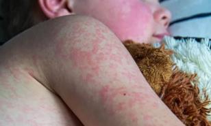 Las autoridades de EE. UU. informan de un cuarto caso de sarampión en Virginia en 2025